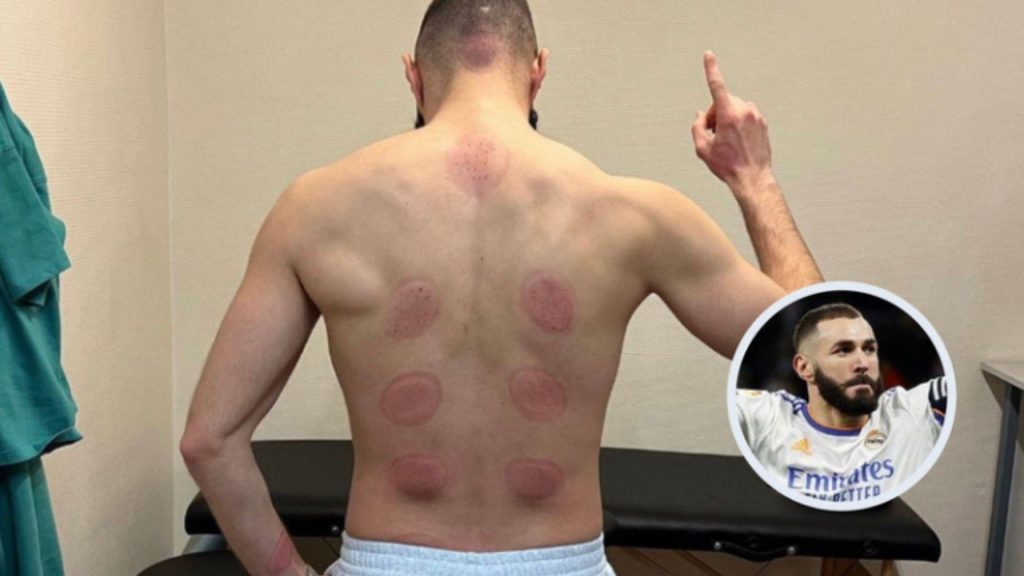 Benzema Hidupkan Sunnah Nabi Dengan Berbekam
